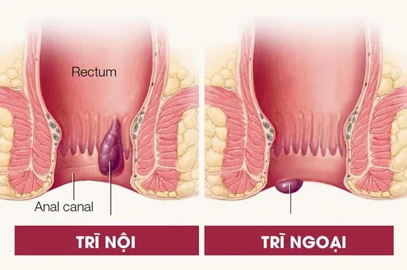 Hình Ảnh Trĩ Tuyển Tập 100+ Ảnh Chân Thực Và Giáo Dục Nhất